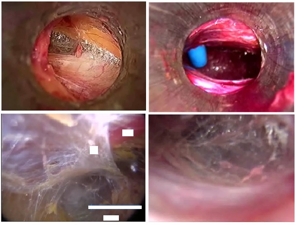 Rectusial Fascia: A New Entity Of Laparoscopic Live Surgical Anatomy